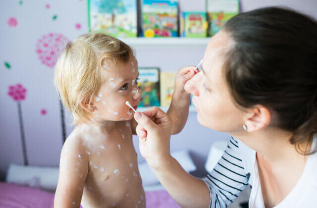 windpocken bei babys und kinder